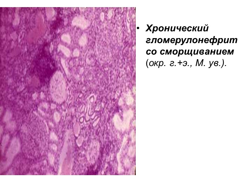 Хронический гломерулонефрит со сморщиванием (окр. г.+э., М. ув.).